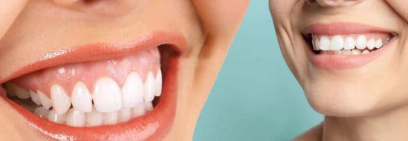 Gummy Smile Nasıl Tedavi Edilir?  Van Diş Kliniği