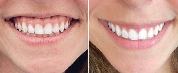 Gummy Smile Nasıl Tedavi Edilir?  Van Diş Kliniği
