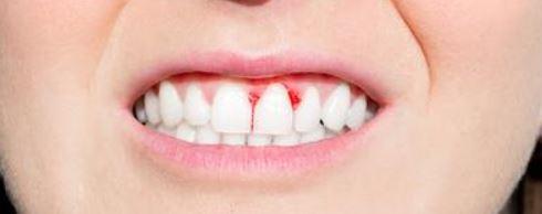 Diş Etlerim Çok Kanıyor? Van Diş Hekimi ile Çözüm Arayın